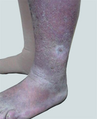 ulcer varicos vondecat