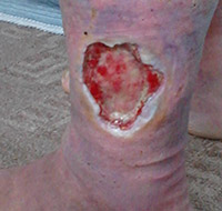 ulcer varicos