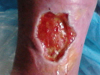 ulcer varicos