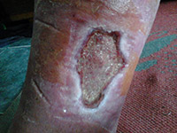 ulcer varicos