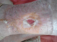 ulcer varicos