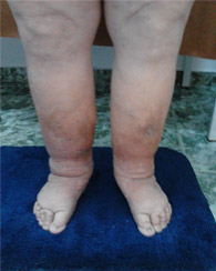 Boala varicoasă sub formă de bump pe picior