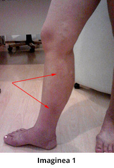 varicoză și eczemă pe picioare)