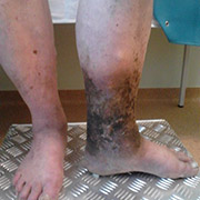 conspiraii de la picior de varicoza