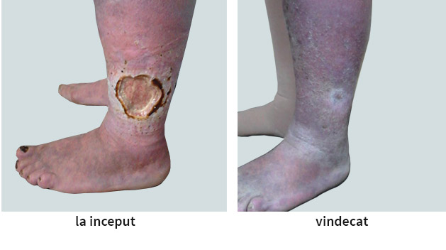 venele varicoase pe picioarele tratamentului ulcerului