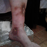 Am salvat piciorul sotului meu de la operatie cu pansamentele umede