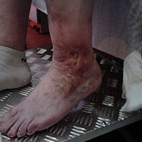 bruisies pe picioare din cauza varicelor)