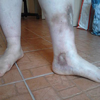 spot negru pe picior varicoza