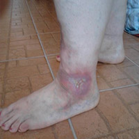 inflamația piciorului varicos)