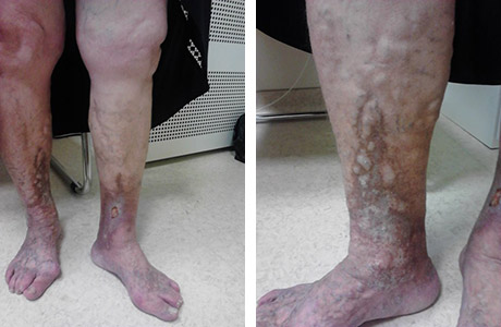 ce este nou în tratamentul varicozei varicoza de brăzdare picior