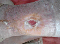 tratament ulcer posttrombotic -cluj-napoca