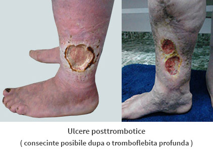 tratament ulcer posttrombotic cluj